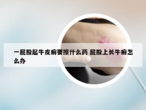 一屁股起牛皮癣要擦什么药 屁股上长牛癣怎么办