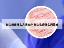 脚生癣用什么方法治疗 脚上生癣什么药最好