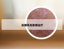 白癜风皮肤病治疗