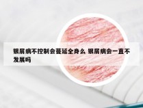 银屑病不控制会蔓延全身么 银屑病会一直不发展吗