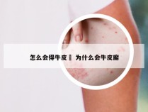 怎么会得牛皮廯 为什么会牛皮廨