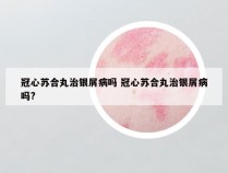 冠心苏合丸治银屑病吗 冠心苏合丸治银屑病吗?