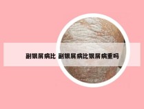 副银屑病比 副银屑病比银屑病重吗