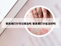 银屑病打针可以根治吗 银屑病打针能治好吗