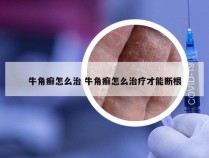 牛角癣怎么治 牛角癣怎么治疗才能断根