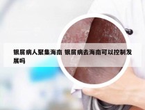 银屑病人聚集海南 银屑病去海南可以控制发展吗