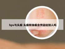 hpv与头癣 头癣和体癣会传染给别人吗