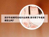 孩子牛皮癣可以吃什么食物 孩子得了牛皮皮癣忌口吗?