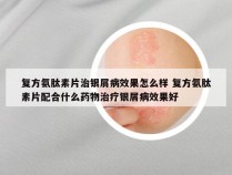 复方氨肽素片治银屑病效果怎么样 复方氨肽素片配合什么药物治疗银屑病效果好