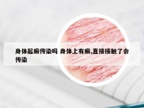 身体起癣传染吗 身体上有癣,直接接触了会传染