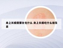 身上长癣需要补充什么 身上长癣吃什么维生素