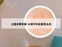 儿童足跟长藓 小孩子长足藓怎么办