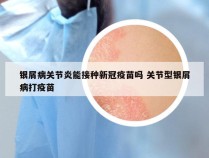 银屑病关节炎能接种新冠疫苗吗 关节型银屑病打疫苗