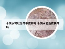 十滴水可以治疗牛皮癣吗 十滴水能治皮肤痒吗