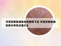 寻常型银屑病表皮突规则下延 寻常型银屑病皮损分布特点是什么