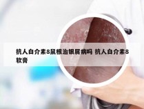 抗人白介素8鼠根治银屑病吗 抗人白介素8软膏