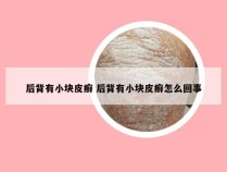 后背有小块皮癣 后背有小块皮癣怎么回事