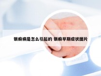 银癣病是怎么引起的 银癣早期症状图片