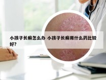 小孩子长癣怎么办 小孩子长癣用什么药比较好?