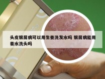 头皮银屑病可以用生姜洗发水吗 银屑病能用姜水洗头吗