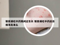 银屑病吃中药期间还生长 银屑病吃中药应该爆发出来么