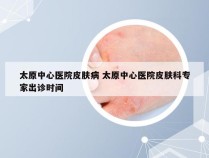 太原中心医院皮肤病 太原中心医院皮肤科专家出诊时间