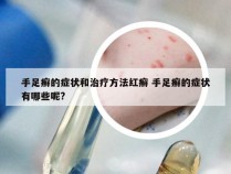 手足癣的症状和治疗方法红癣 手足癣的症状有哪些呢?