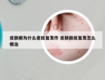 皮肤癣为什么老反复发作 皮肤藓反复发怎么根治