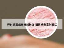 开封银屑病当听刘长江 银屑病专家刘长江