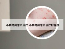 小孩出藓怎么治疗 小孩出藓怎么治疗好得快