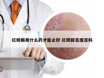 红班癣用什么药才能止好 红斑藓百度百科