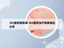 301医院银屑病 301医院治疗银屑病怎么样