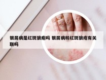 银屑病是红斑狼疱吗 银屑病和红斑狼疮有关联吗