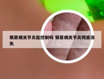 银屑病关节炎能控制吗 银屑病关节炎彻底消失