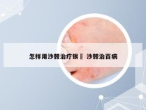 怎样用沙棘治疗银痟 沙棘治百病