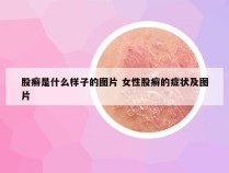 股癣是什么样子的图片 女性股癣的症状及图片