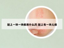 腿上一块一块癣用什么药 腿上有一块儿癣