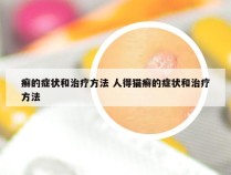 癣的症状和治疗方法 人得猫癣的症状和治疗方法