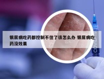 银屑病吃药都控制不住了该怎么办 银屑病吃药没效果