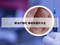 廨治疗图片 廨症状图片大全