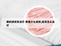 癣的症状及治疗 癣是什么症状,应该怎么治疗