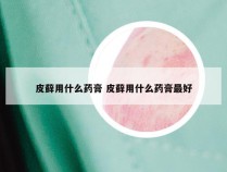 皮藓用什么药膏 皮藓用什么药膏最好