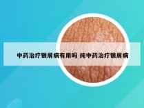 中药治疗银屑病有用吗 纯中药治疗银屑病