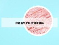 偃师治牛皮癣 偃师皮肤科