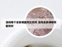 洛阳哪个皮肤病医院比较好 洛阳皮肤病哪家医院好