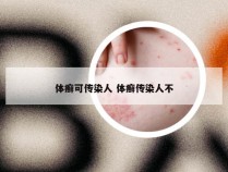 体癣可传染人 体癣传染人不