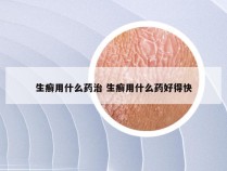 生癣用什么药治 生癣用什么药好得快