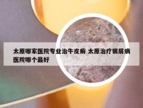 太原哪家医院专业治牛皮癣 太原治疗银屑病医院哪个最好