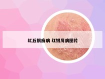 红丘银癣病 红银屑病图片