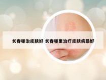 长春哪治皮肤好 长春哪里治疗皮肤病最好